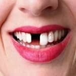 Mancanza di uno o più denti